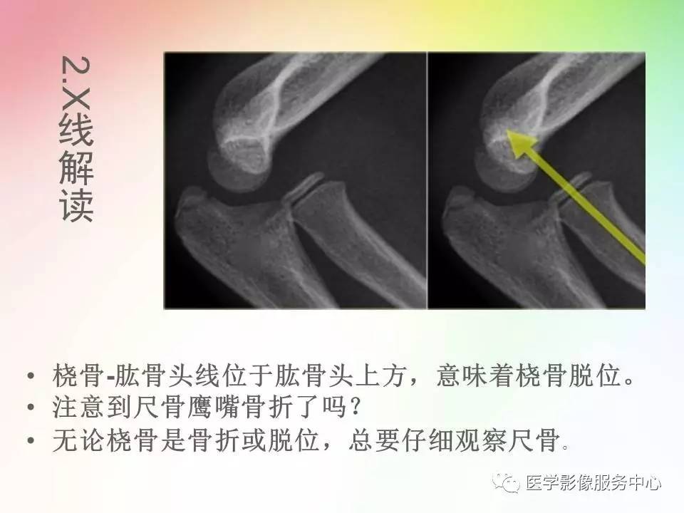 儿童肘关节骨折的分类与诊断要点