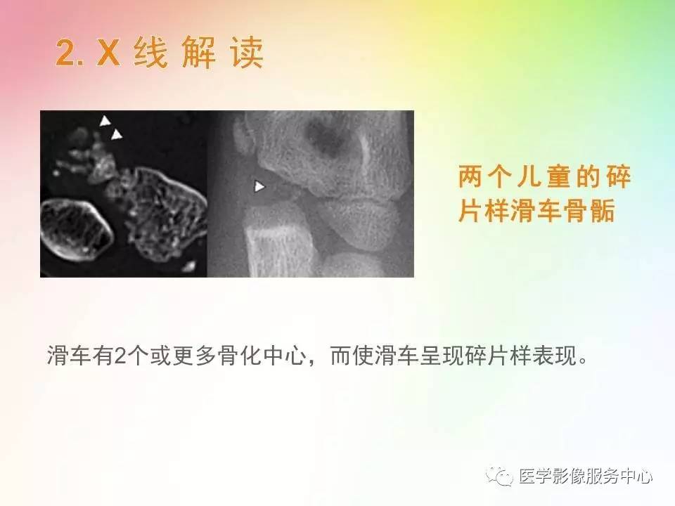 儿童肘关节骨折的分类与诊断要点