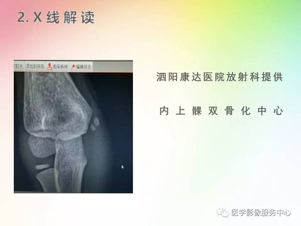 儿童肘关节骨折的分类与诊断要点