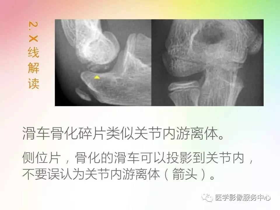 儿童肘关节骨折的分类与诊断要点