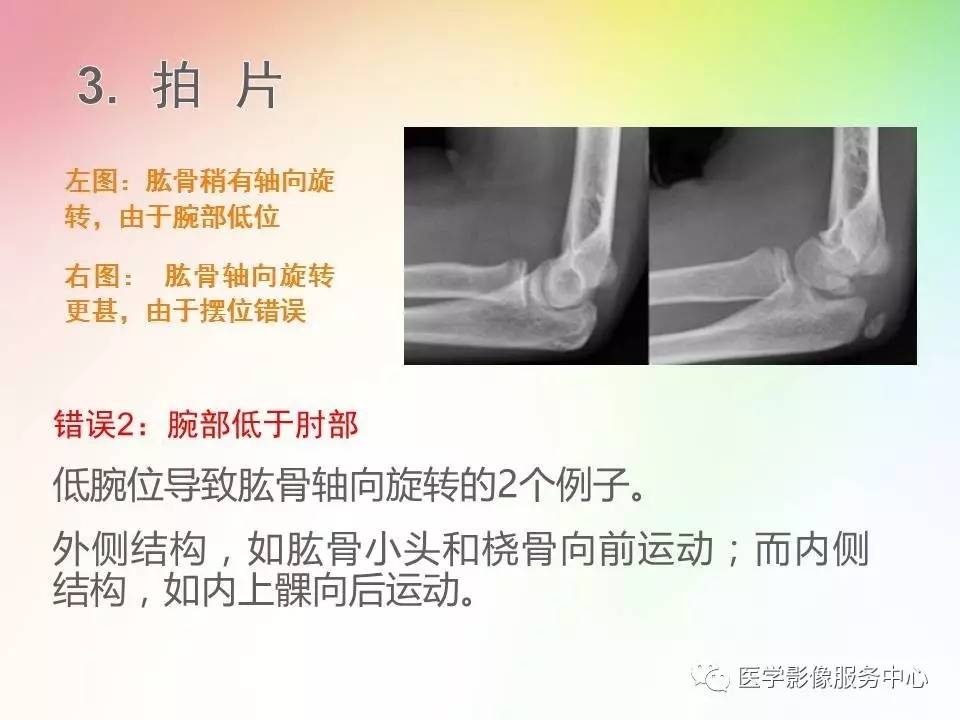 儿童肘关节骨折的分类与诊断要点
