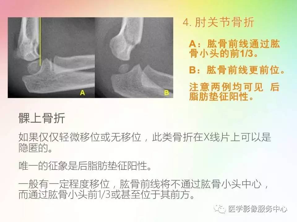 儿童肘关节骨折的分类与诊断要点