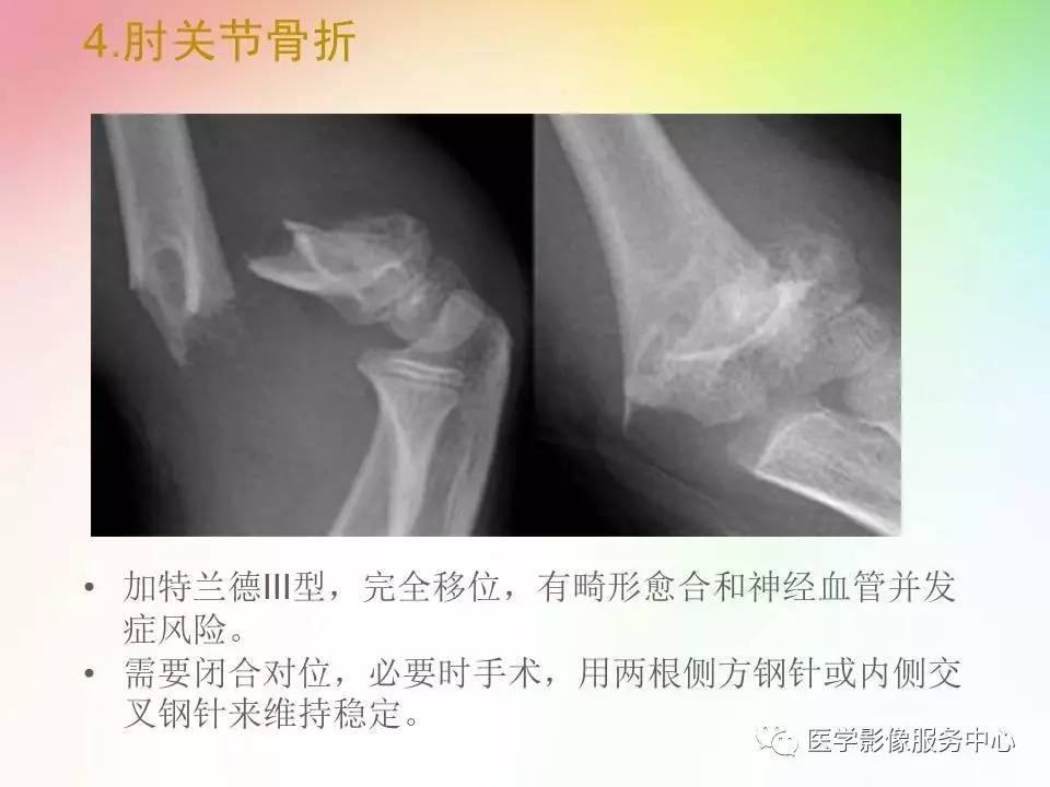 儿童肘关节骨折的分类与诊断要点
