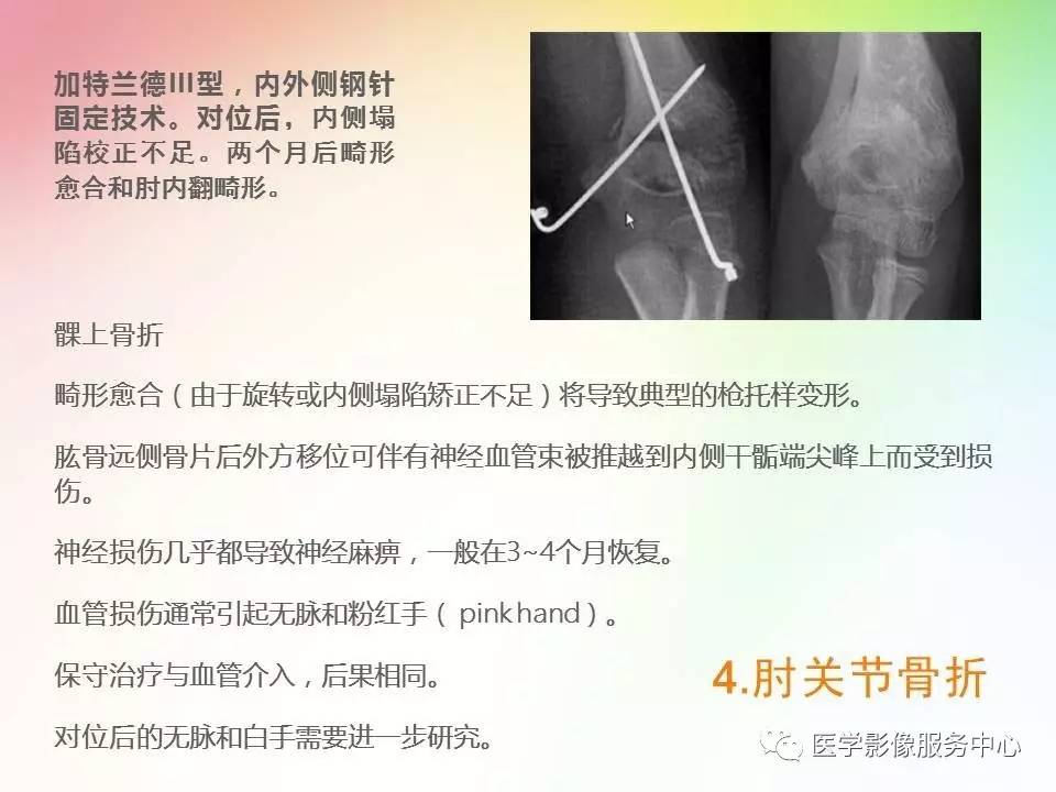 儿童肘关节骨折的分类与诊断要点