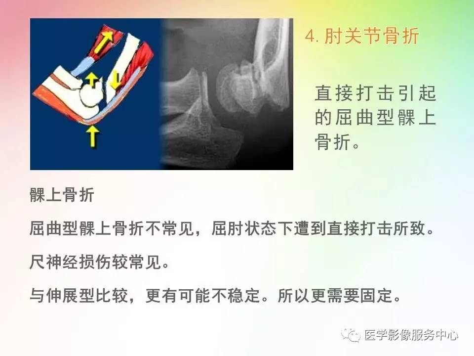 儿童肘关节骨折的分类与诊断要点