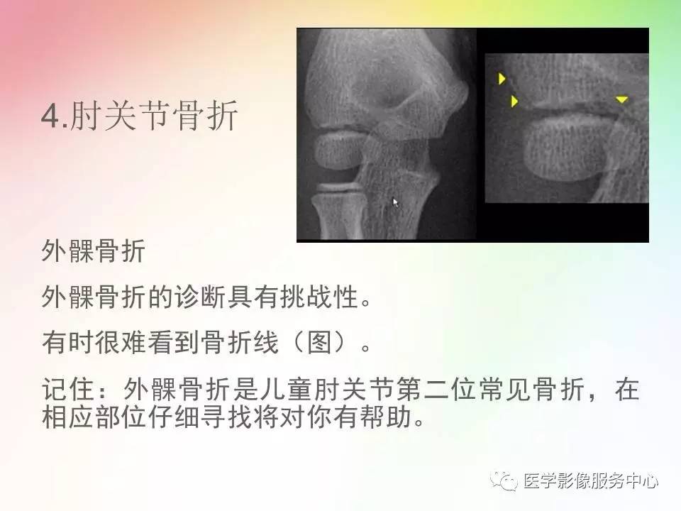 儿童肘关节骨折的分类与诊断要点