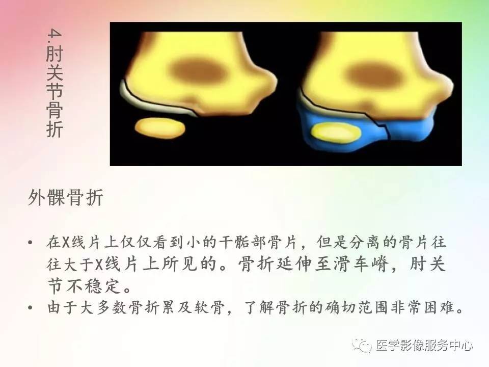 儿童肘关节骨折的分类与诊断要点