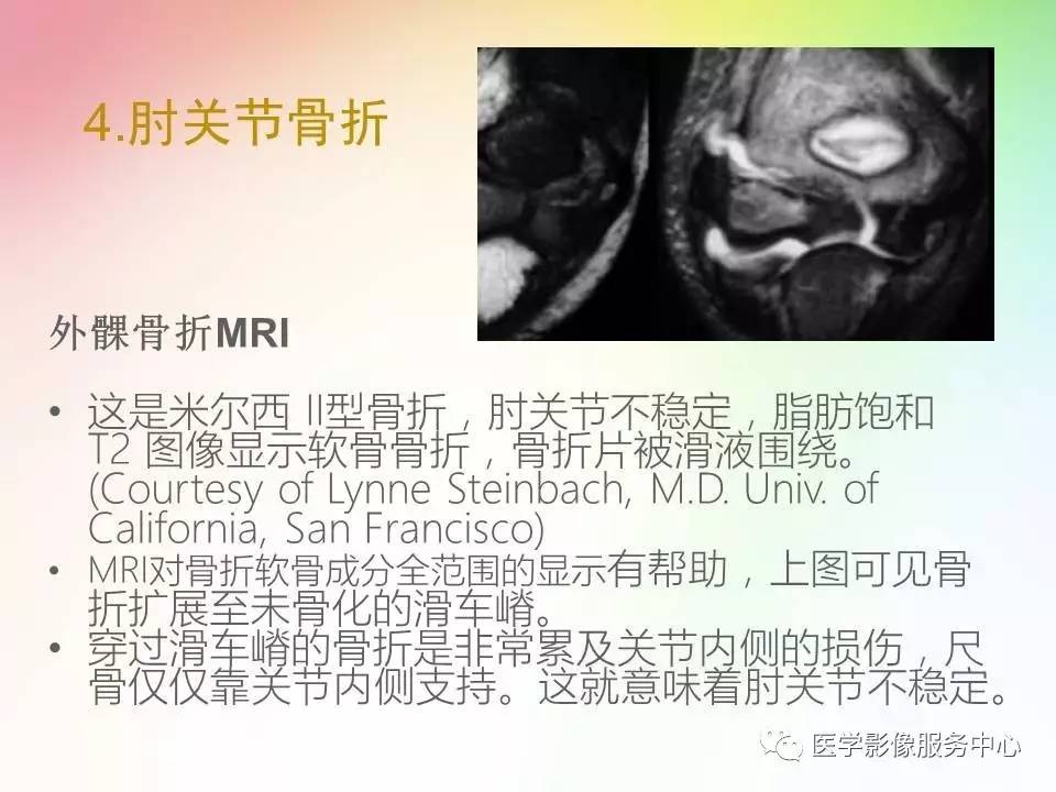 儿童肘关节骨折的分类与诊断要点