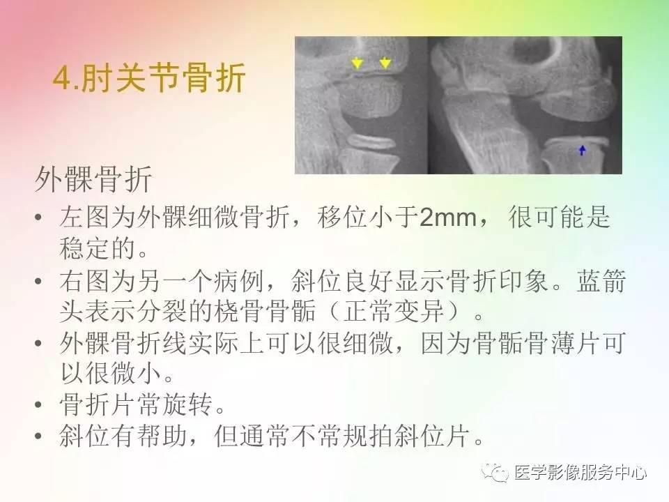 儿童肘关节骨折的分类与诊断要点
