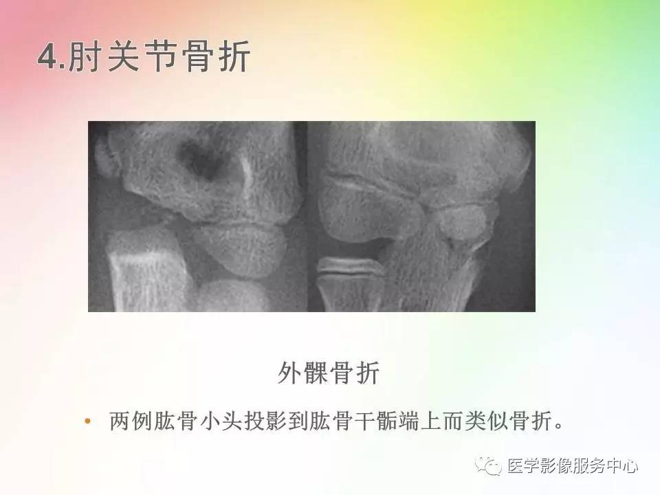 儿童肘关节骨折的分类与诊断要点