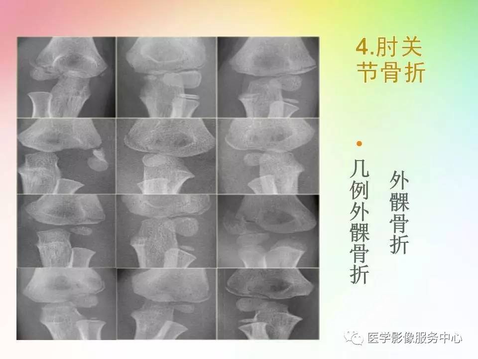 儿童肘关节骨折的分类与诊断要点