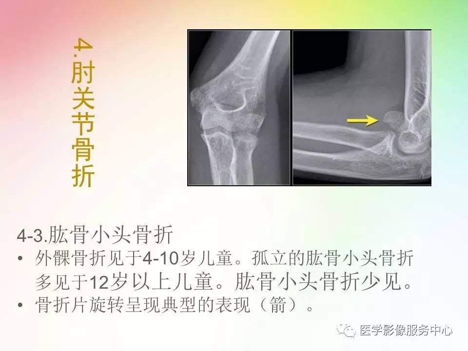 儿童肘关节骨折的分类与诊断要点