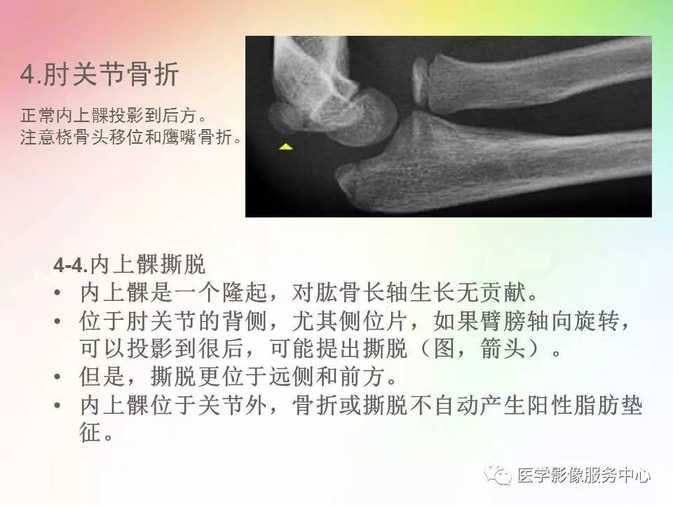 儿童肘关节骨折的分类与诊断要点