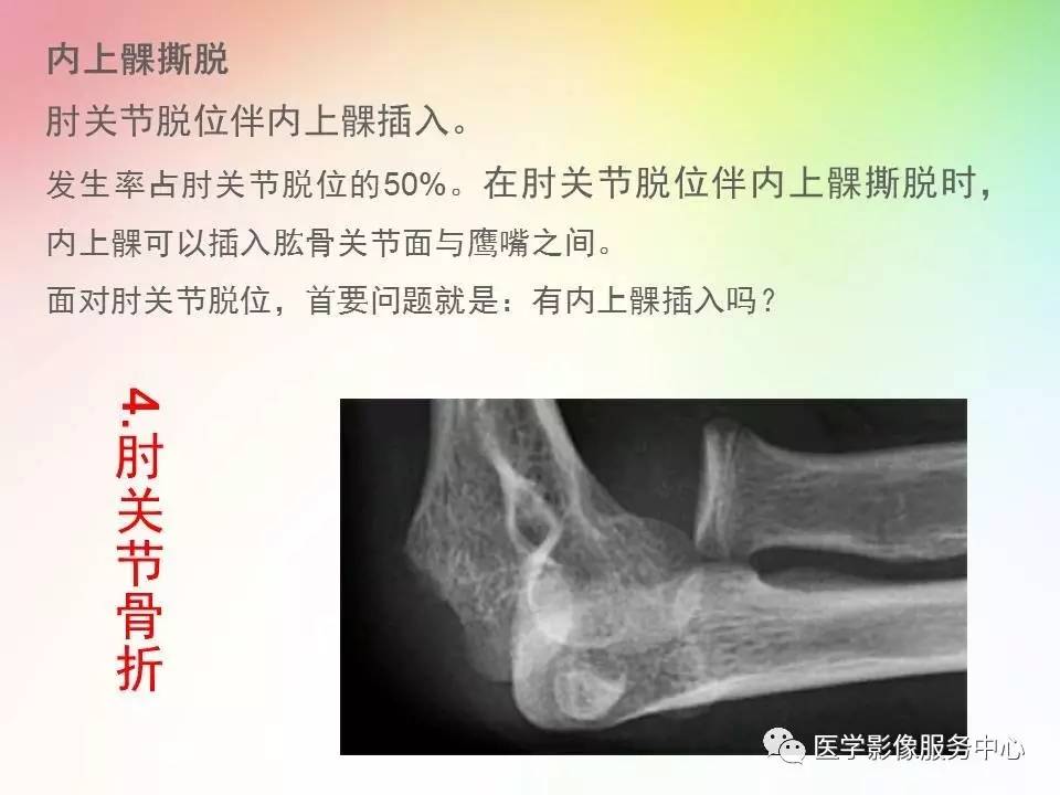 儿童肘关节骨折的分类与诊断要点
