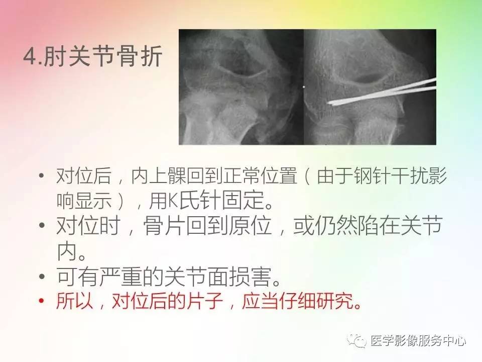 儿童肘关节骨折的分类与诊断要点