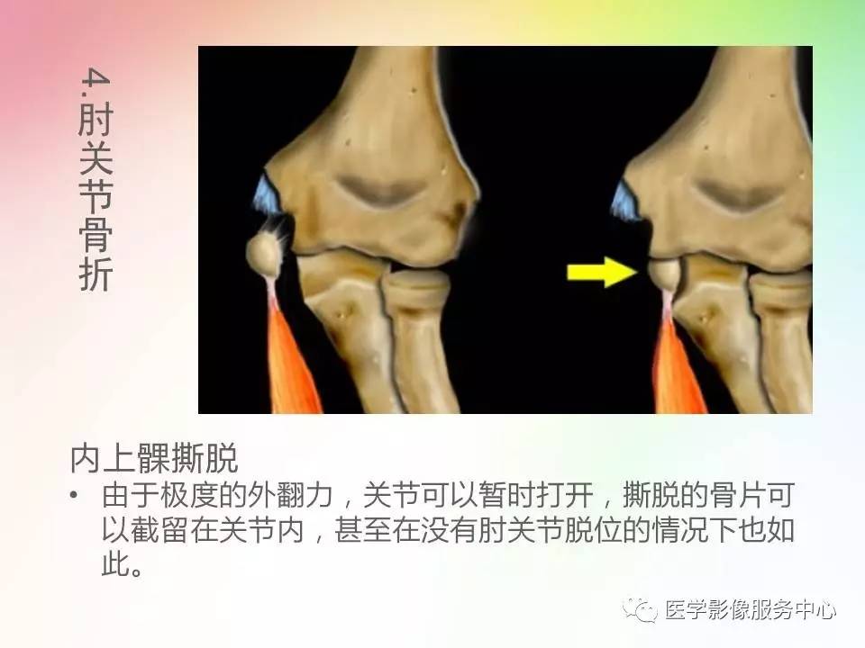 儿童肘关节骨折的分类与诊断要点