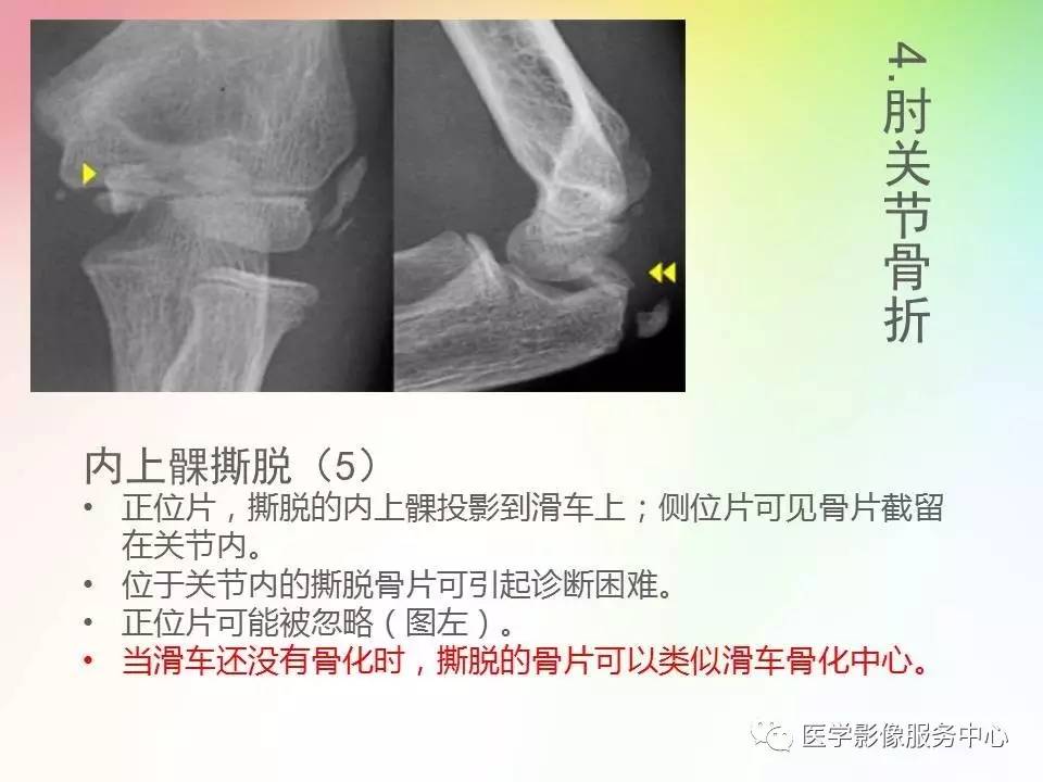 儿童肘关节骨折的分类与诊断要点