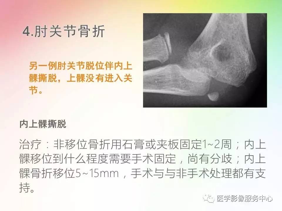 儿童肘关节骨折的分类与诊断要点