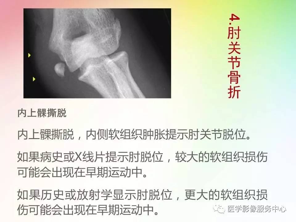 儿童肘关节骨折的分类与诊断要点