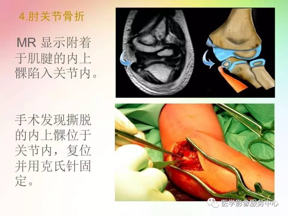 儿童肘关节骨折的分类与诊断要点
