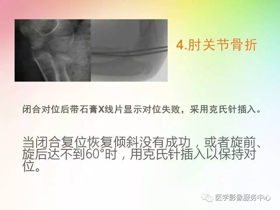 儿童肘关节骨折的分类与诊断要点