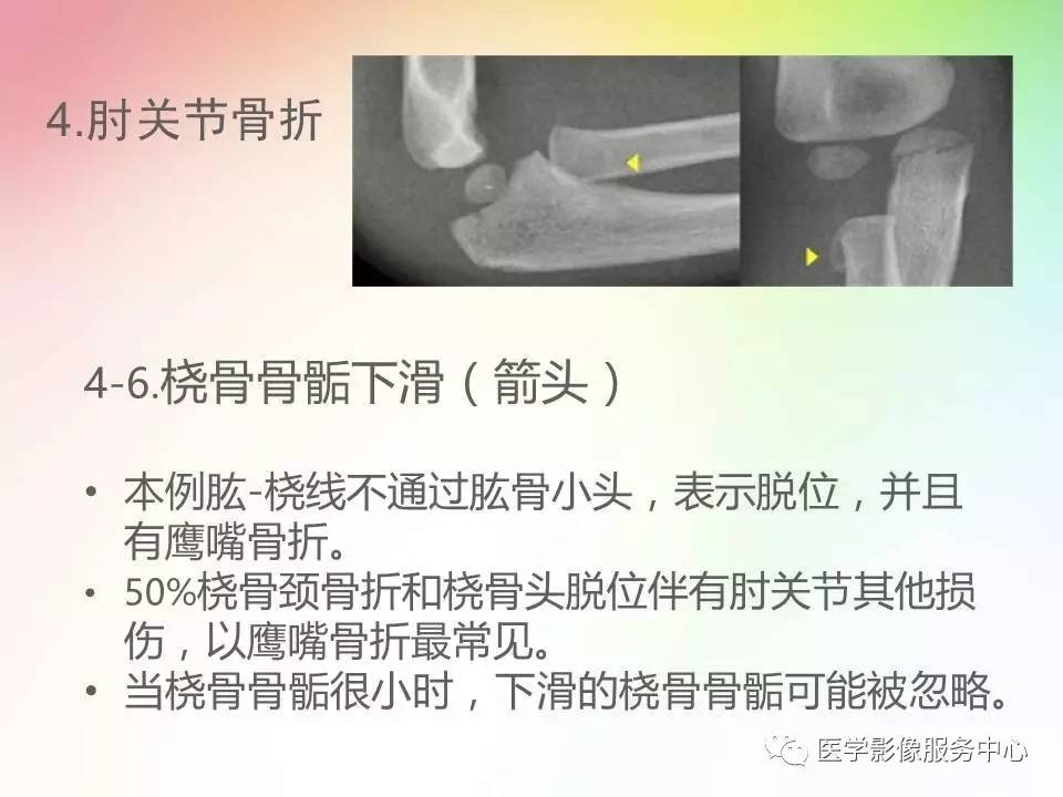 儿童肘关节骨折的分类与诊断要点