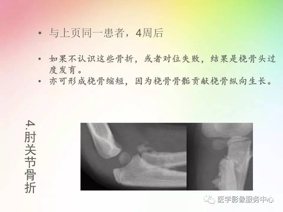 儿童肘关节骨折的分类与诊断要点