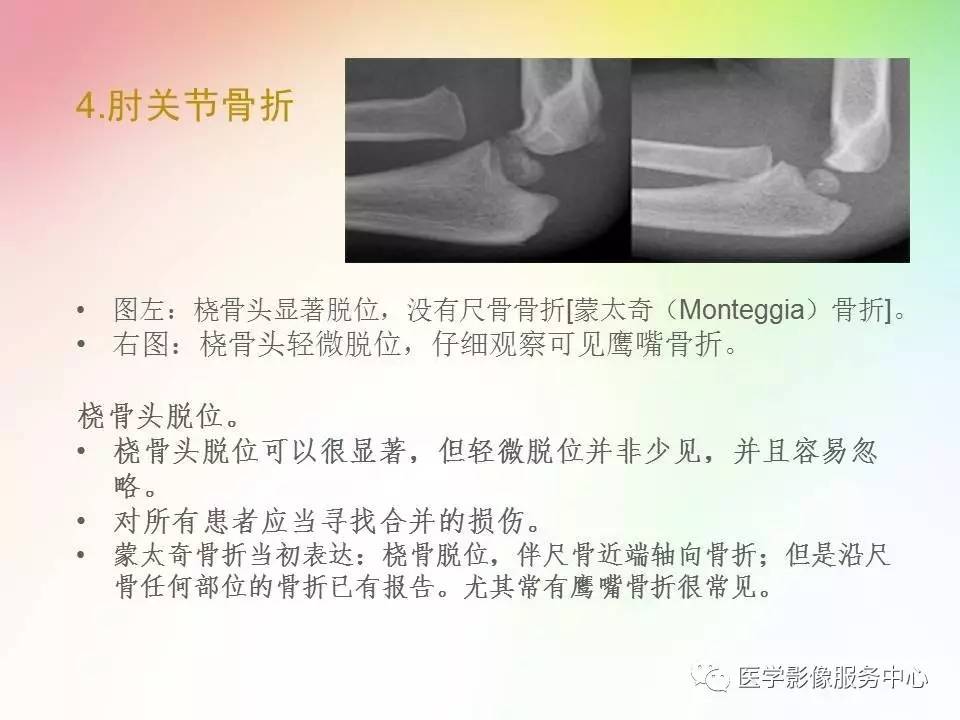 儿童肘关节骨折的分类与诊断要点