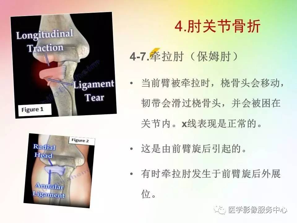儿童肘关节骨折的分类与诊断要点