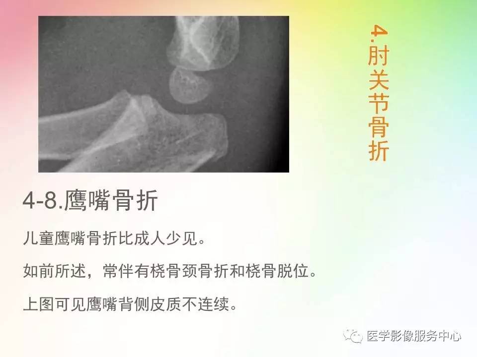 儿童肘关节骨折的分类与诊断要点