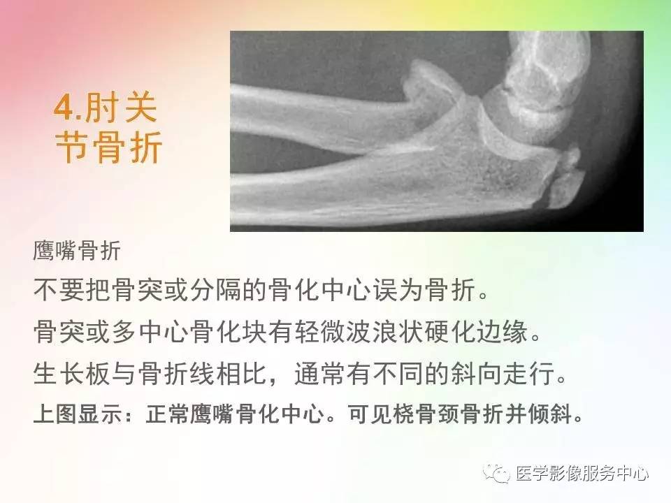 儿童肘关节骨折的分类与诊断要点