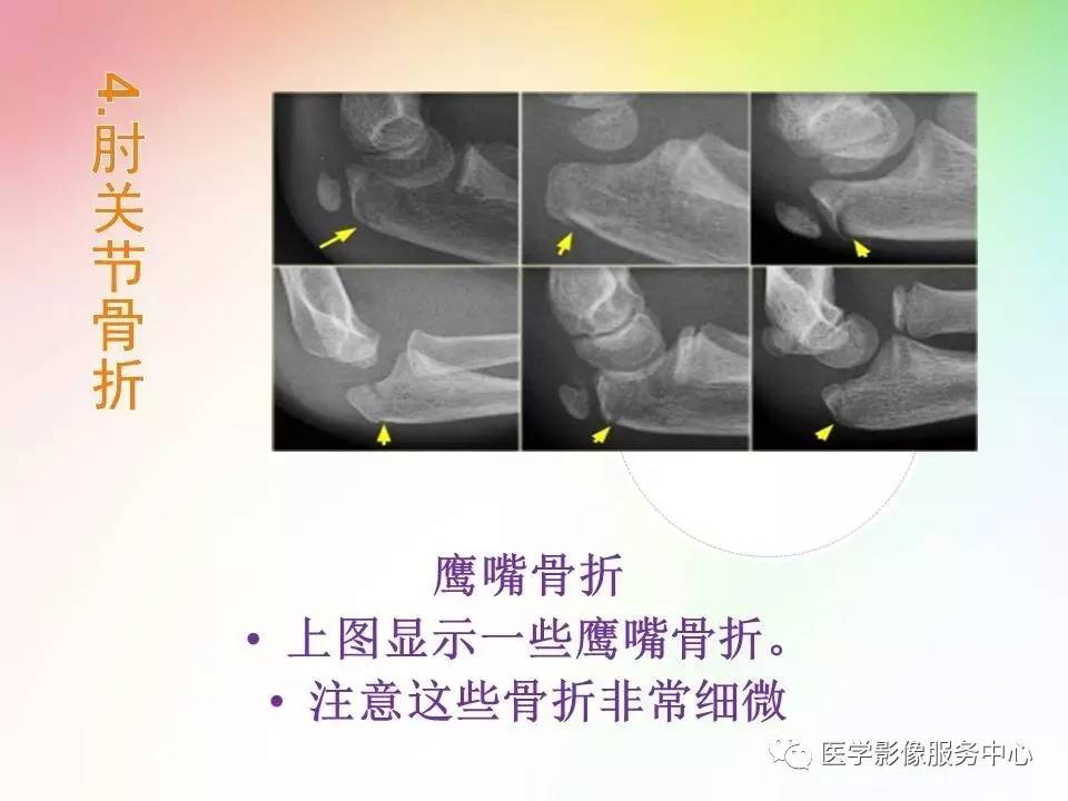 儿童肘关节骨折的分类与诊断要点