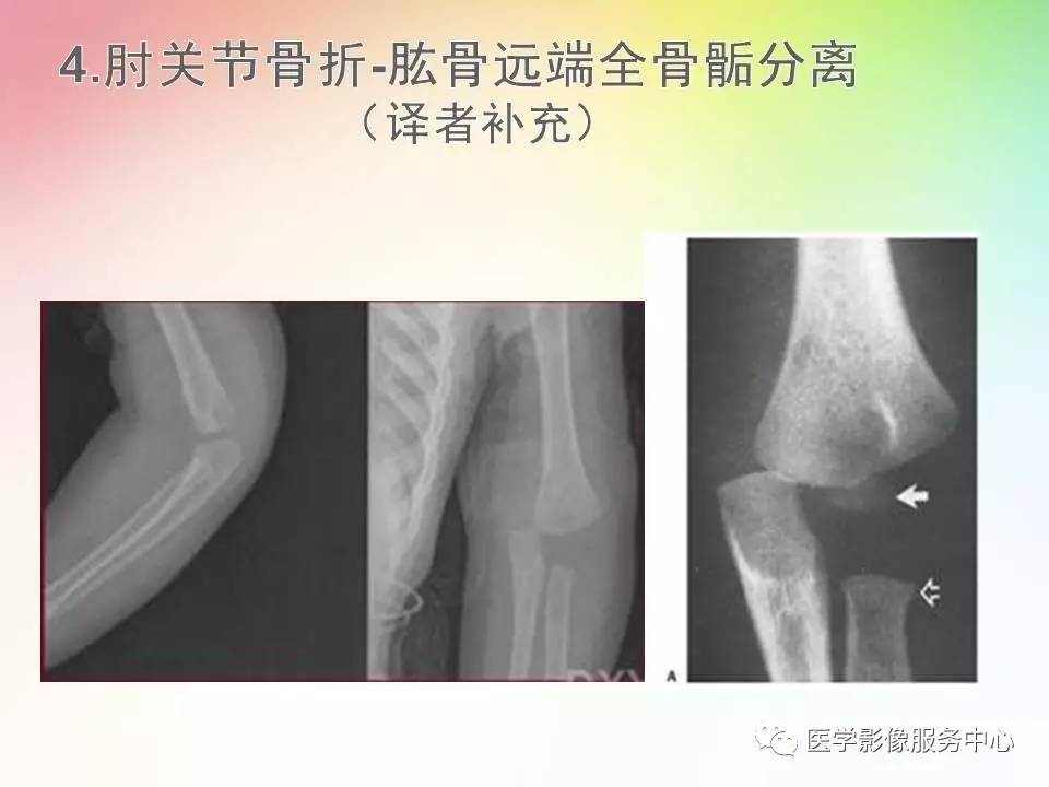 儿童肘关节骨折的分类与诊断要点