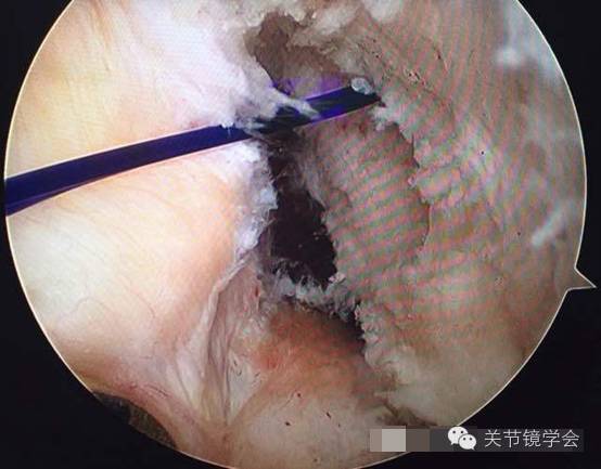 前交叉韧带自体腘绳肌腱重建术