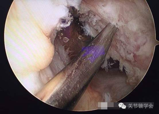 前交叉韧带自体腘绳肌腱重建术