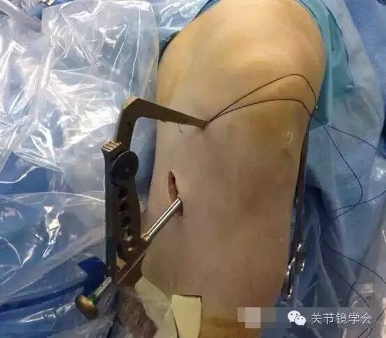 前交叉韧带自体腘绳肌腱重建术