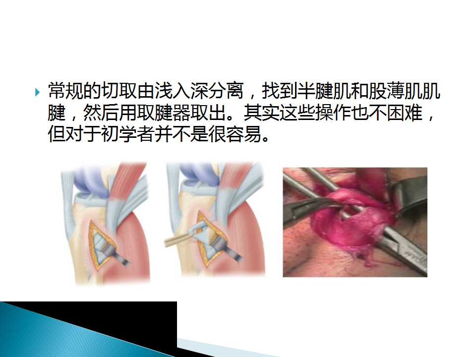 如何能够快速切取腘绳肌腱？