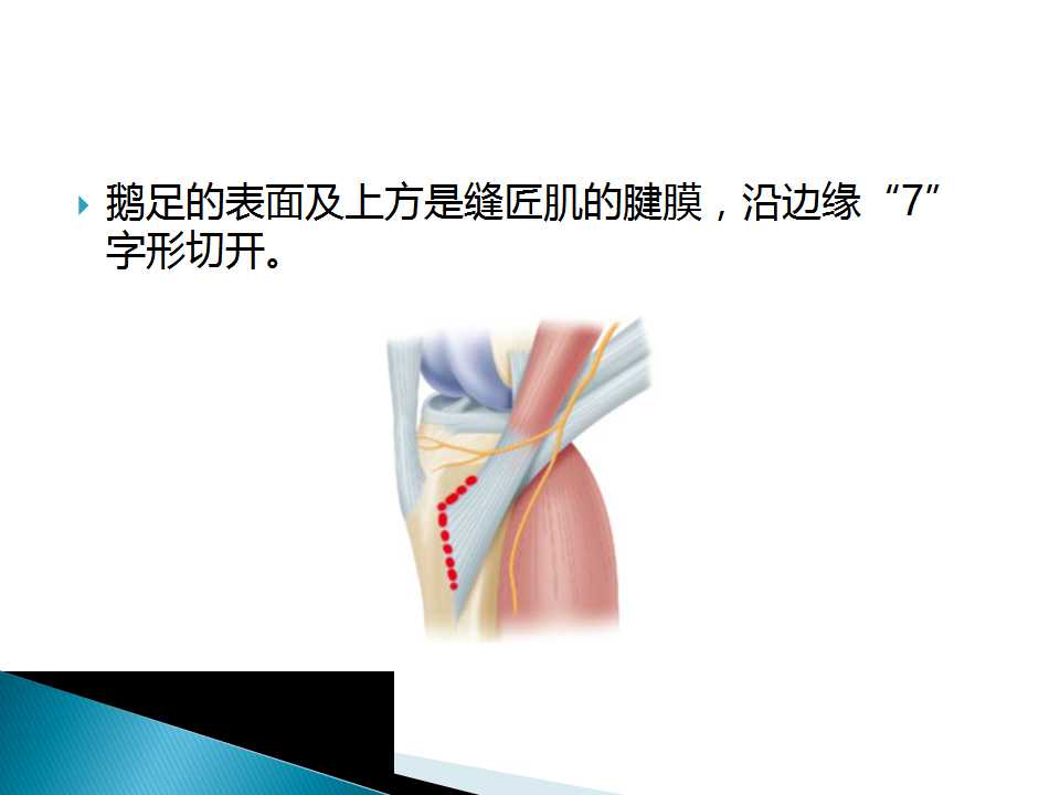 如何能够快速切取腘绳肌腱？