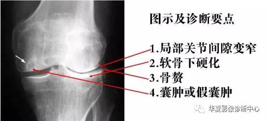 常见膝关节炎有五类，你能分清吗？