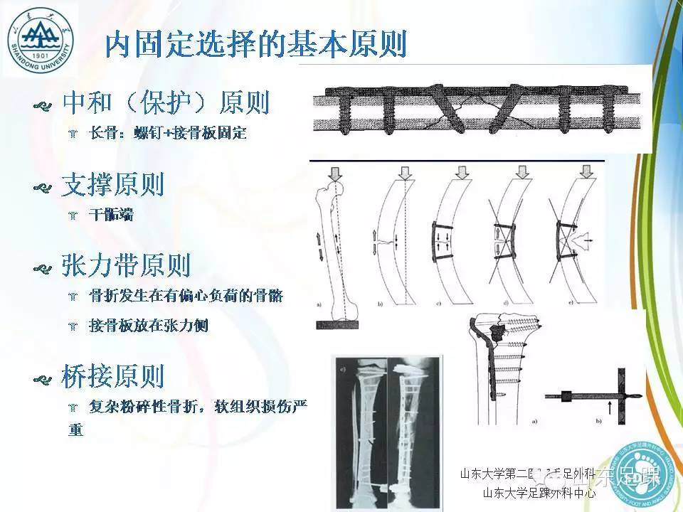 Pilon骨折的分型及治疗要点