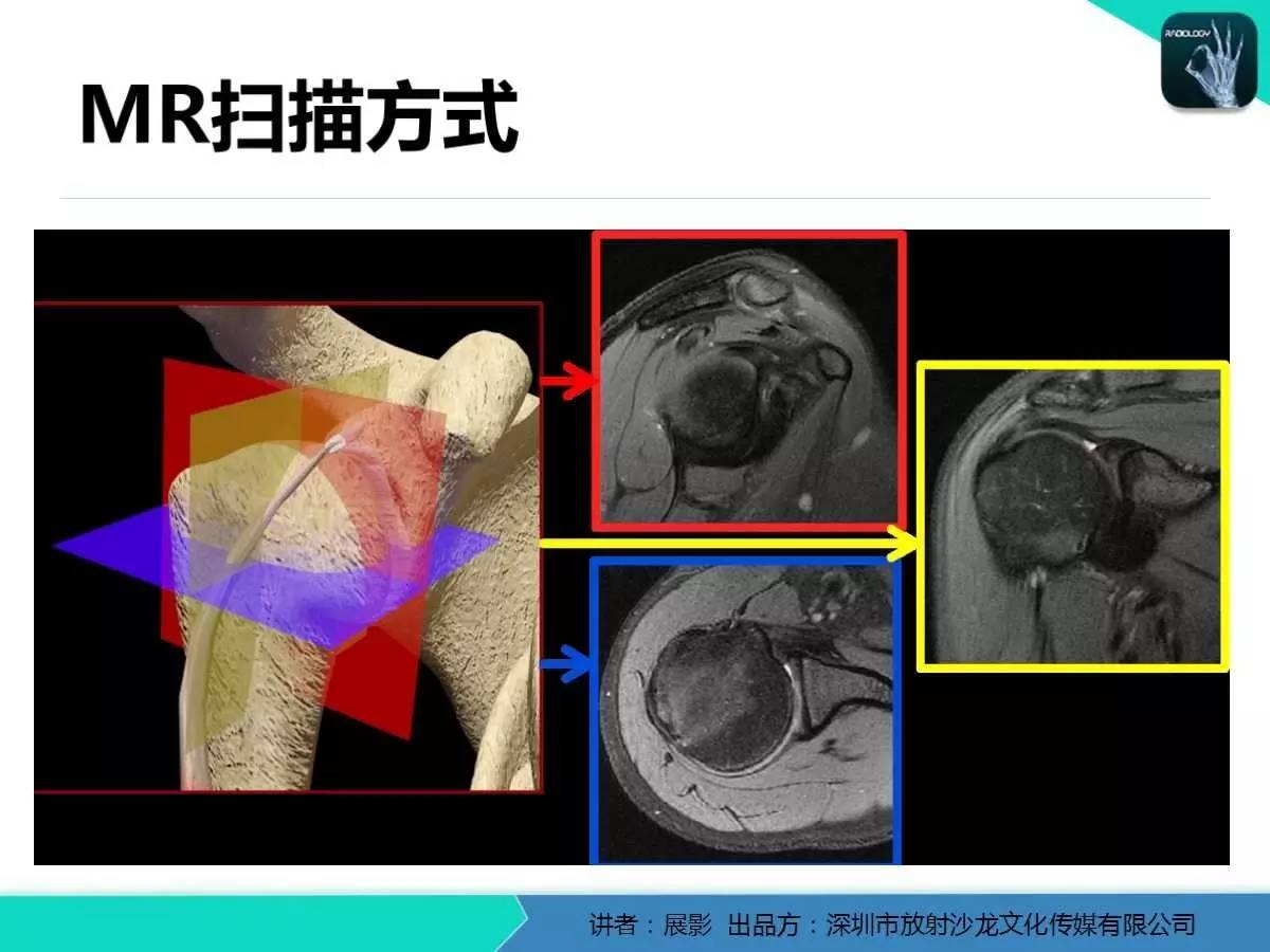 肩峰下撞击综合征和肩袖损伤的MR表现