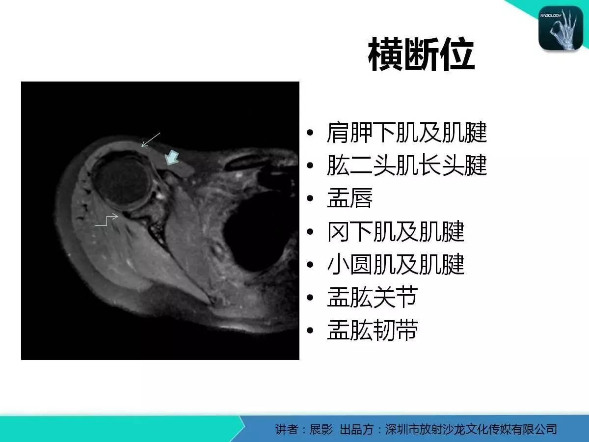 肩峰下撞击综合征和肩袖损伤的MR表现