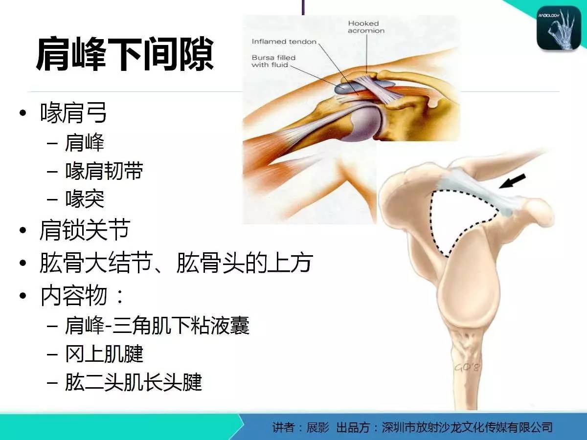 肩峰下撞击综合征和肩袖损伤的MR表现