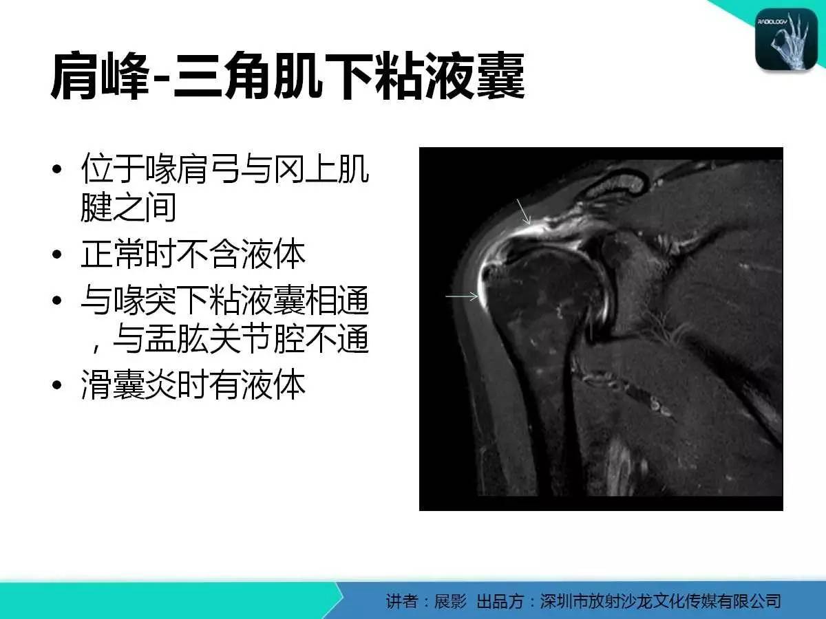 肩峰下撞击综合征和肩袖损伤的MR表现