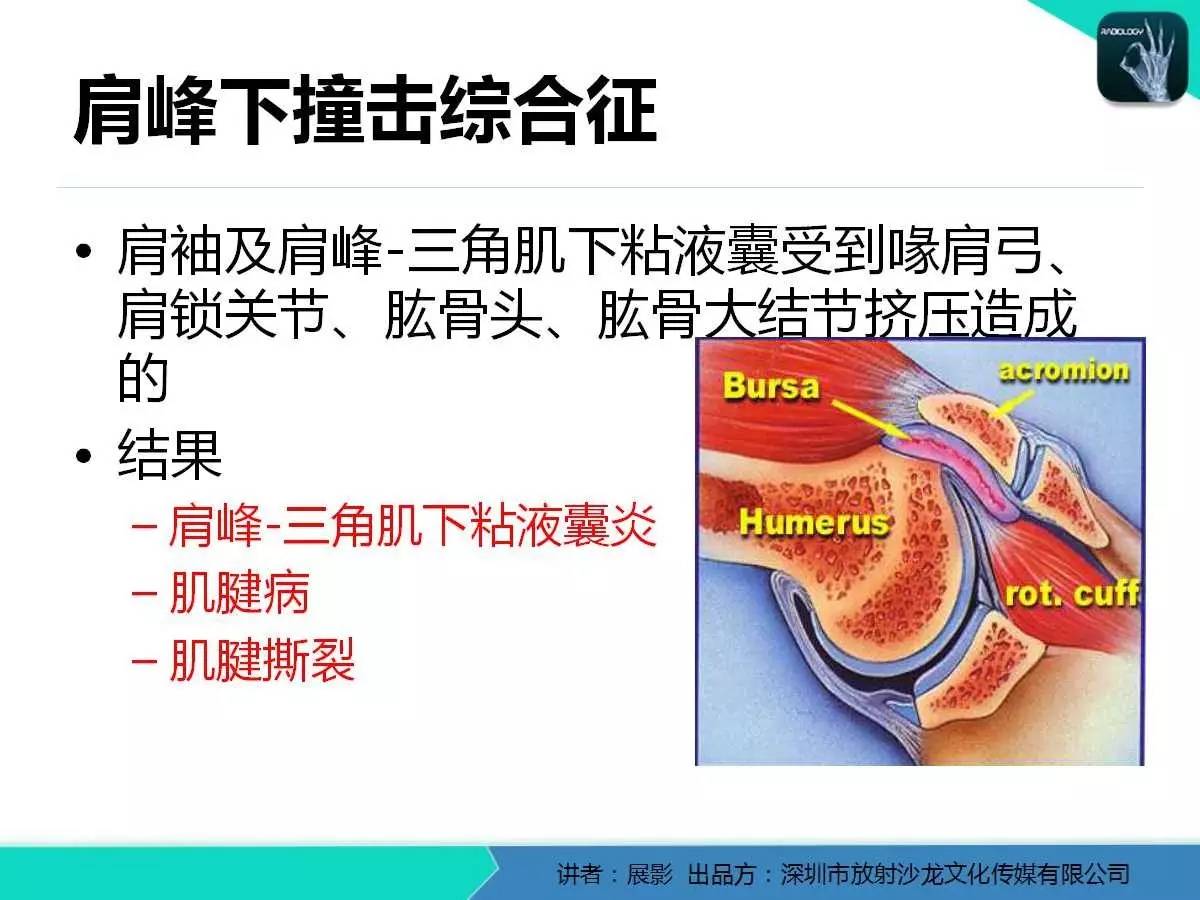 肩峰下撞击综合征和肩袖损伤的MR表现