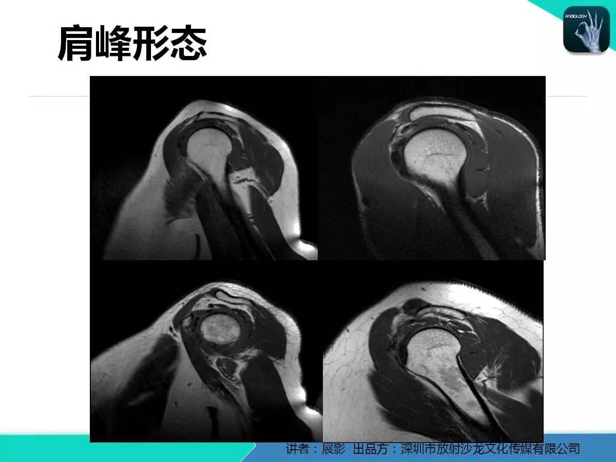 肩峰下撞击综合征和肩袖损伤的MR表现