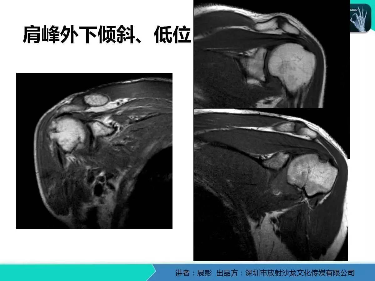 肩峰下撞击综合征和肩袖损伤的MR表现