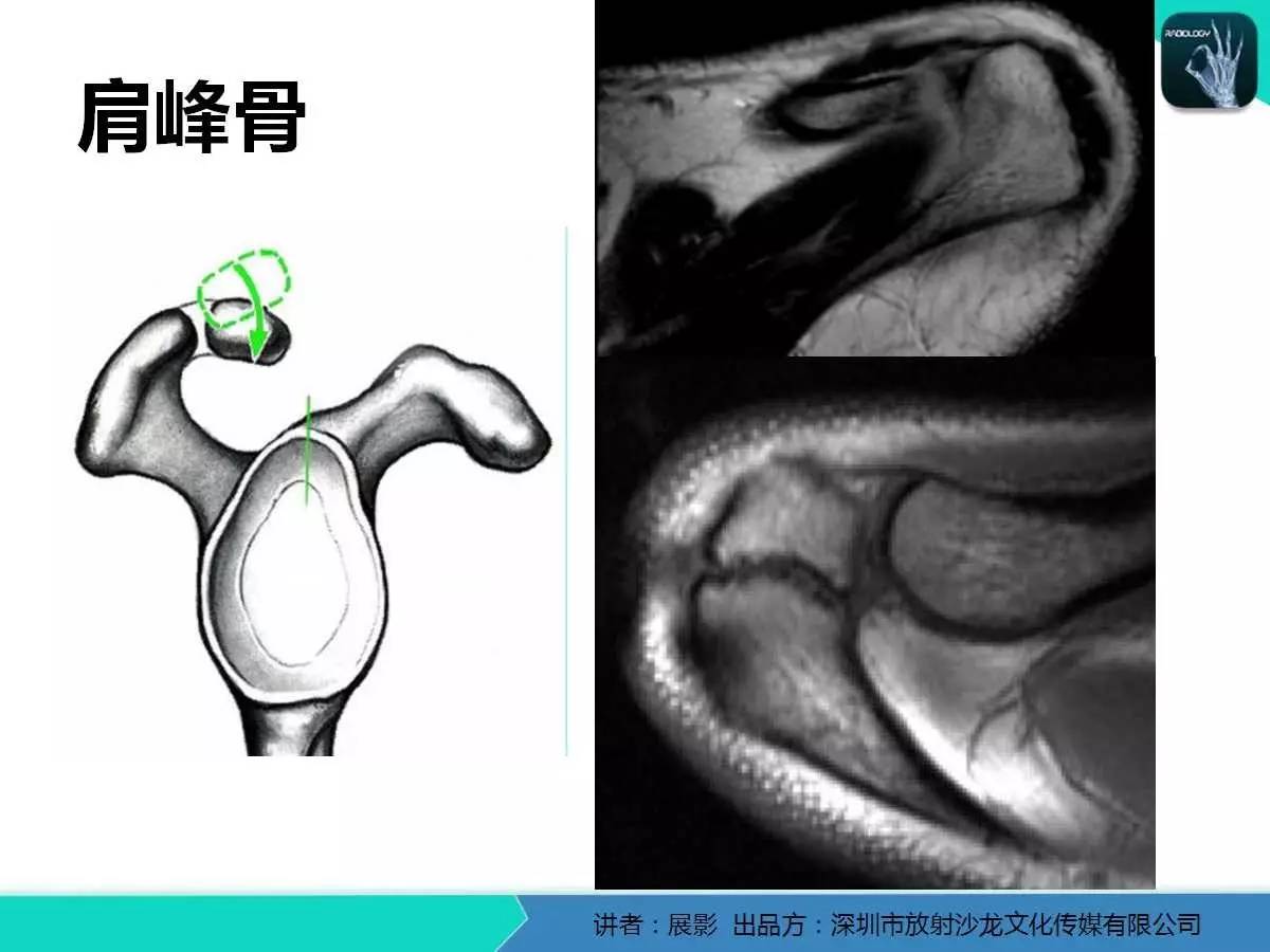 肩峰下撞击综合征和肩袖损伤的MR表现