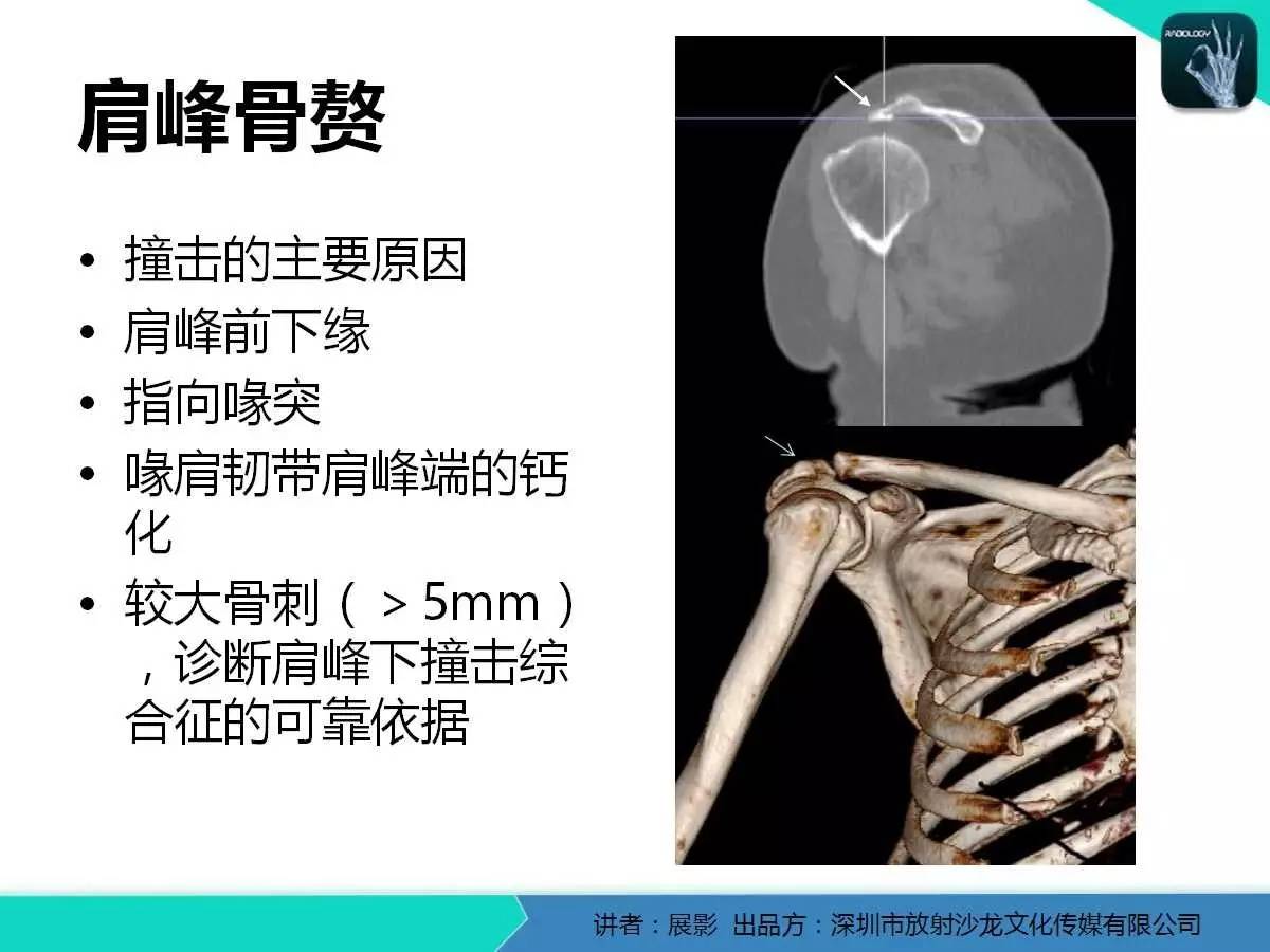 肩峰下撞击综合征和肩袖损伤的MR表现