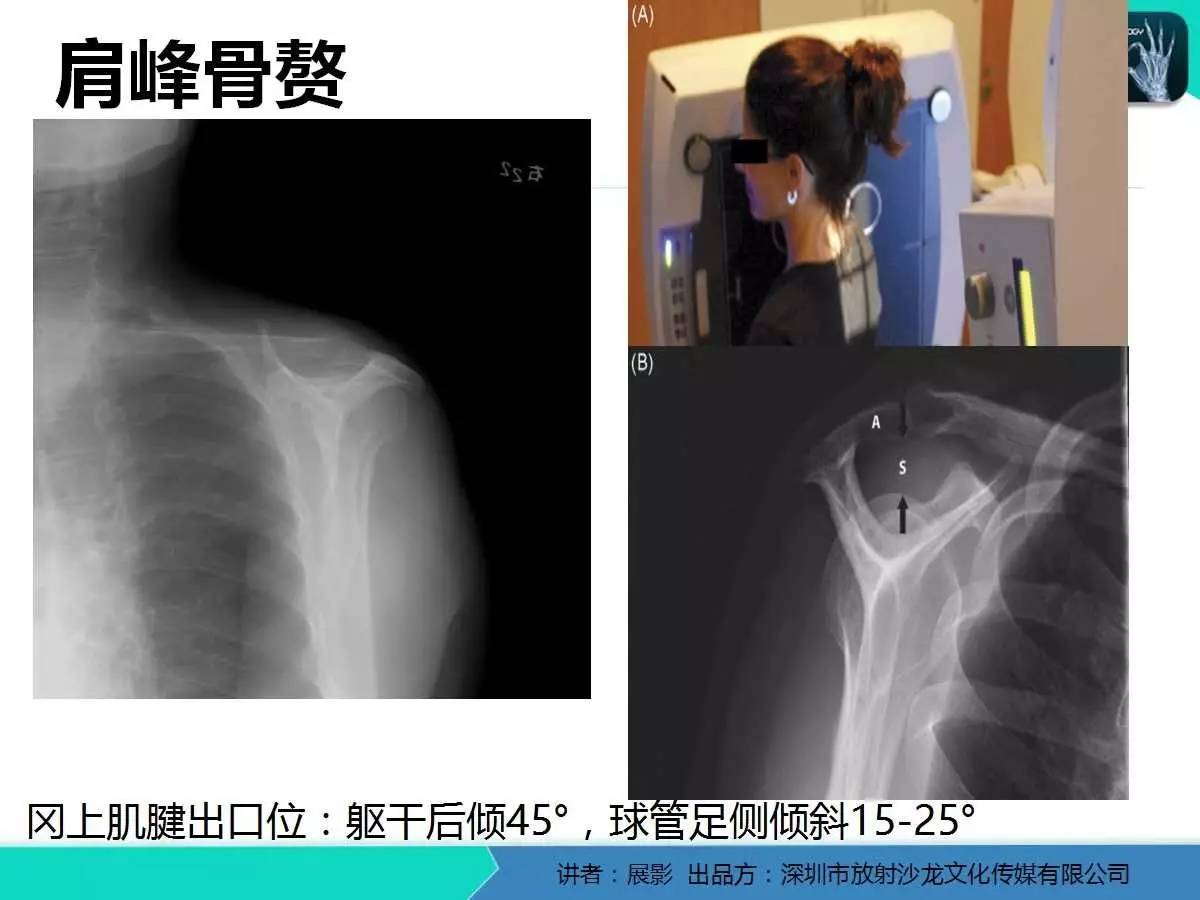 肩峰下撞击综合征和肩袖损伤的MR表现